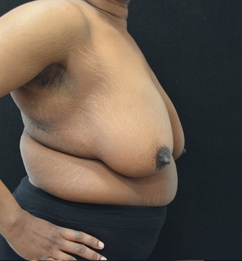 Breast Reduction Before & After Gallery - Patient 102583384 - Image 9