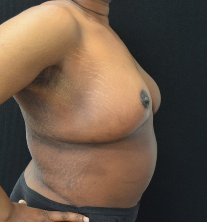 Breast Reduction Before & After Gallery - Patient 102583384 - Image 10