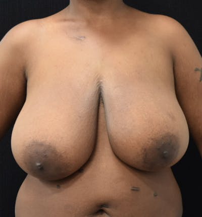 Breast Reduction Before & After Gallery - Patient 102583391 - Image 1