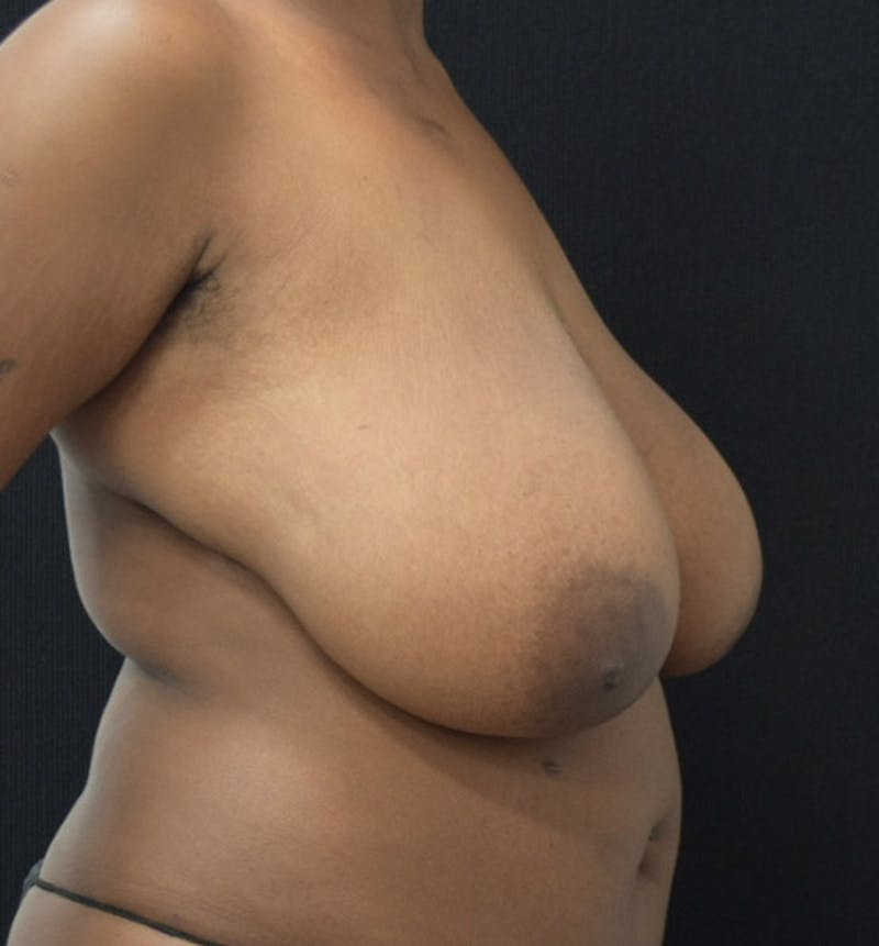 Breast Reduction Before & After Gallery - Patient 102583391 - Image 7