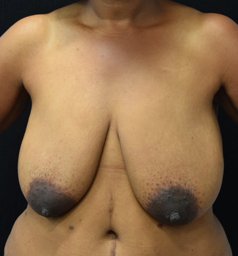Breast Reduction Before & After Gallery - Patient 102583404 - Image 1