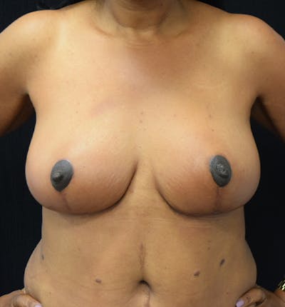 Breast Reduction Before & After Gallery - Patient 102583404 - Image 2