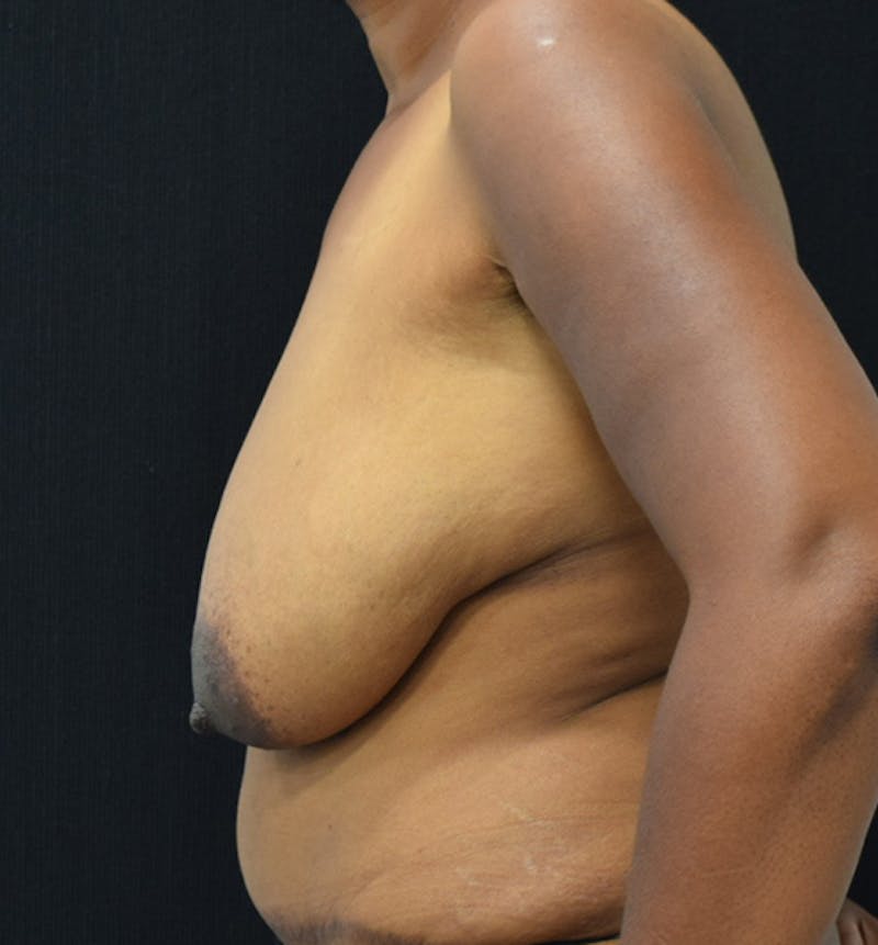 Breast Reduction Gallery - Patient 102583404 - Image 5