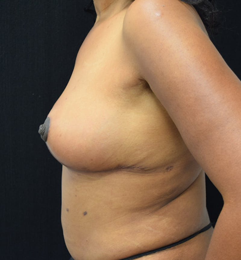 Breast Reduction Gallery - Patient 102583404 - Image 6