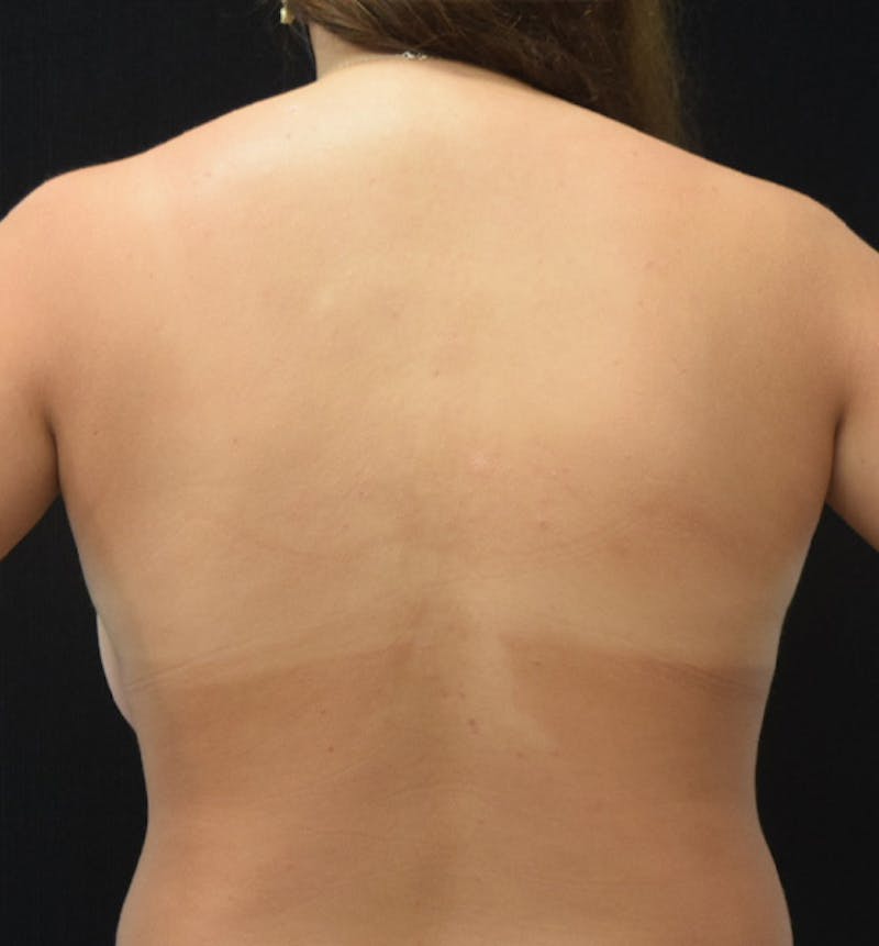 Breast Reduction Before & After Gallery - Patient 102583417 - Image 7
