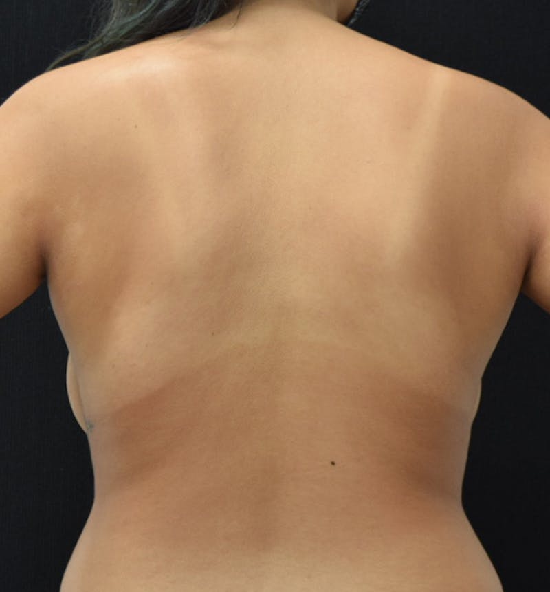 Breast Reduction Before & After Gallery - Patient 102583419 - Image 11
