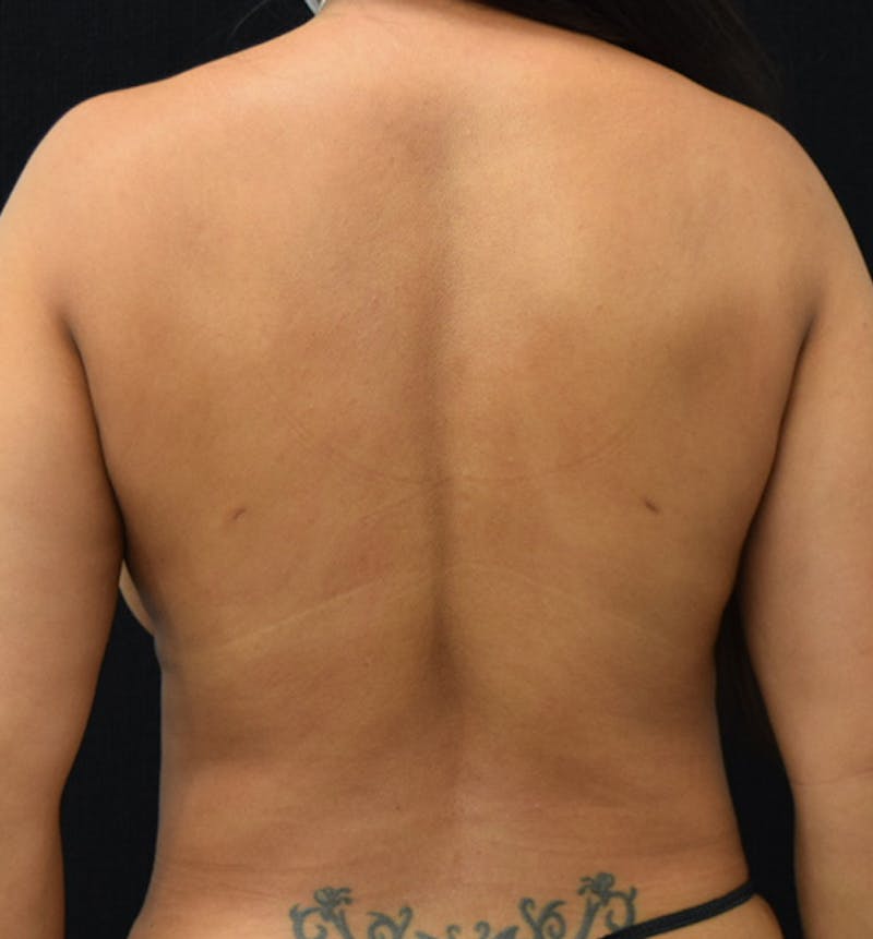 Breast Reduction Before & After Gallery - Patient 102583433 - Image 11