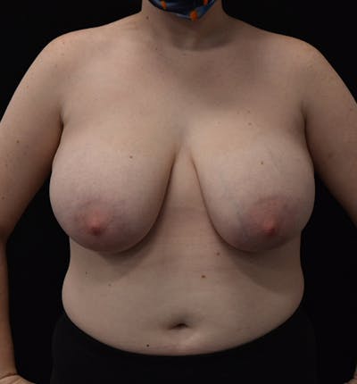 Breast Reduction Before & After Gallery - Patient 102583444 - Image 1