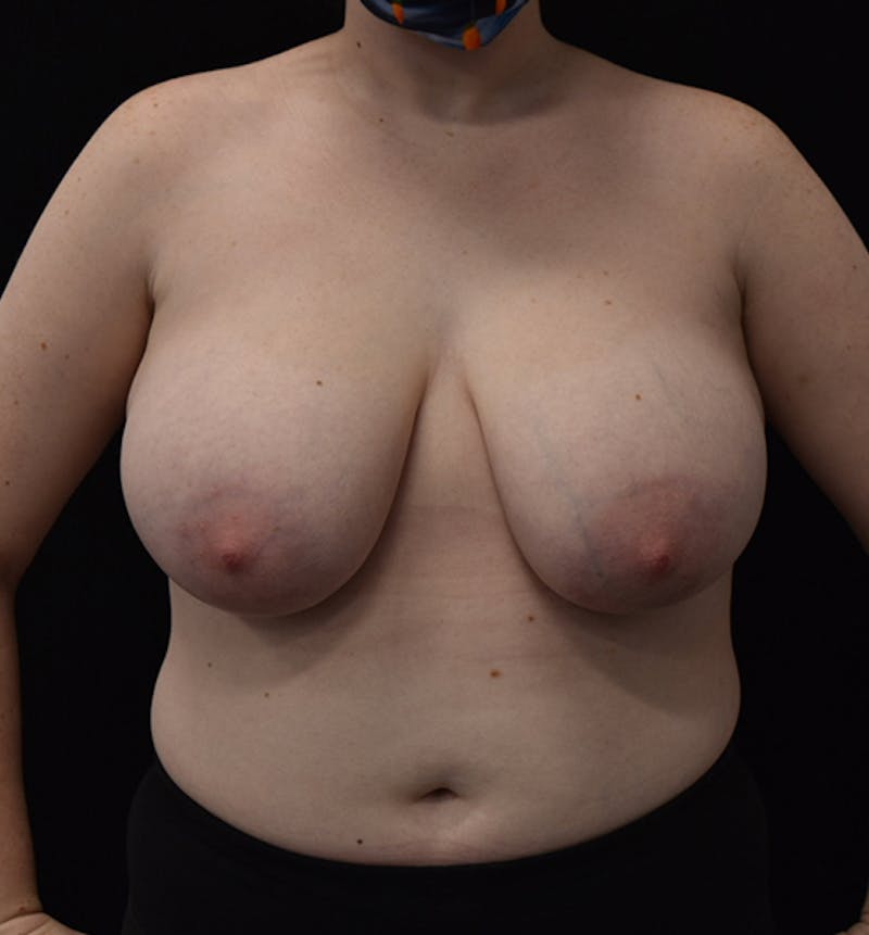 Breast Reduction Before & After Gallery - Patient 102583444 - Image 1