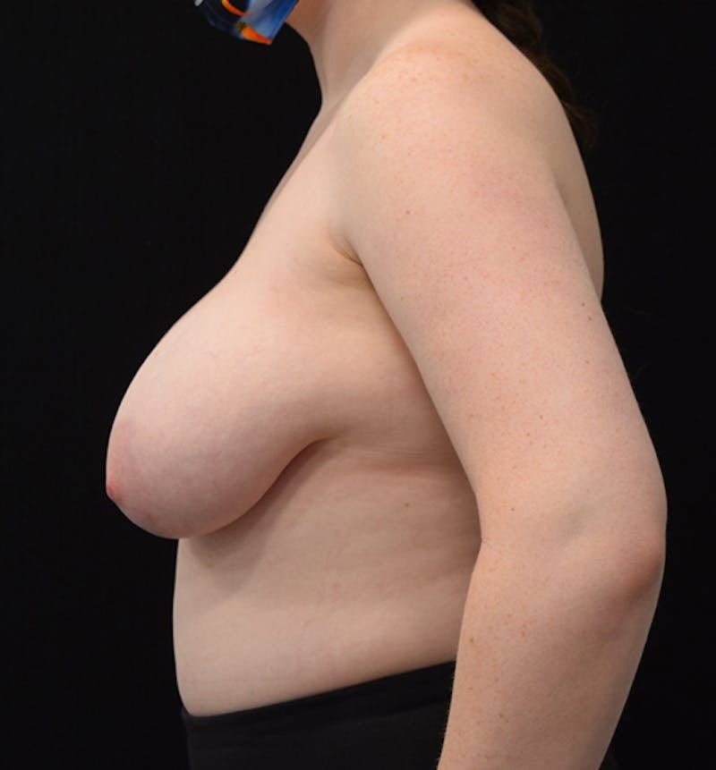 Breast Reduction Before & After Gallery - Patient 102583444 - Image 5