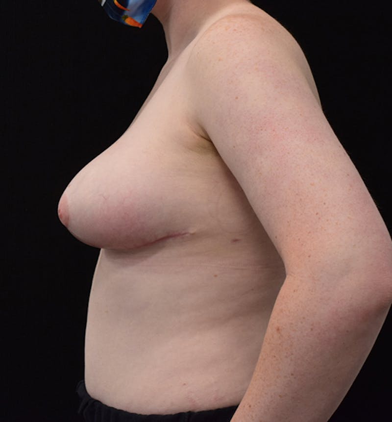 Breast Reduction Before & After Gallery - Patient 102583444 - Image 6