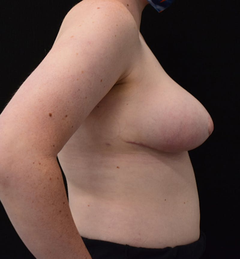 Breast Reduction Before & After Gallery - Patient 102583444 - Image 10