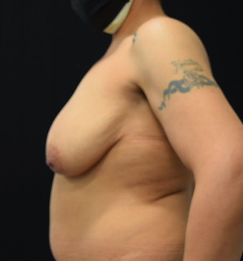 Breast Reduction Before & After Gallery - Patient 102583450 - Image 5