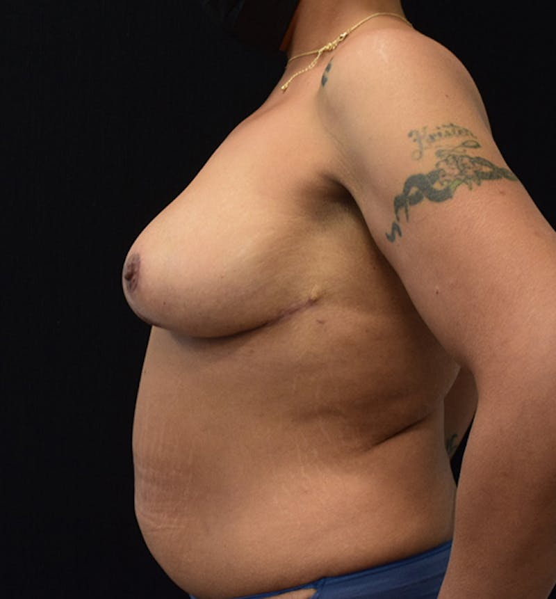 Breast Reduction Before & After Gallery - Patient 102583450 - Image 6