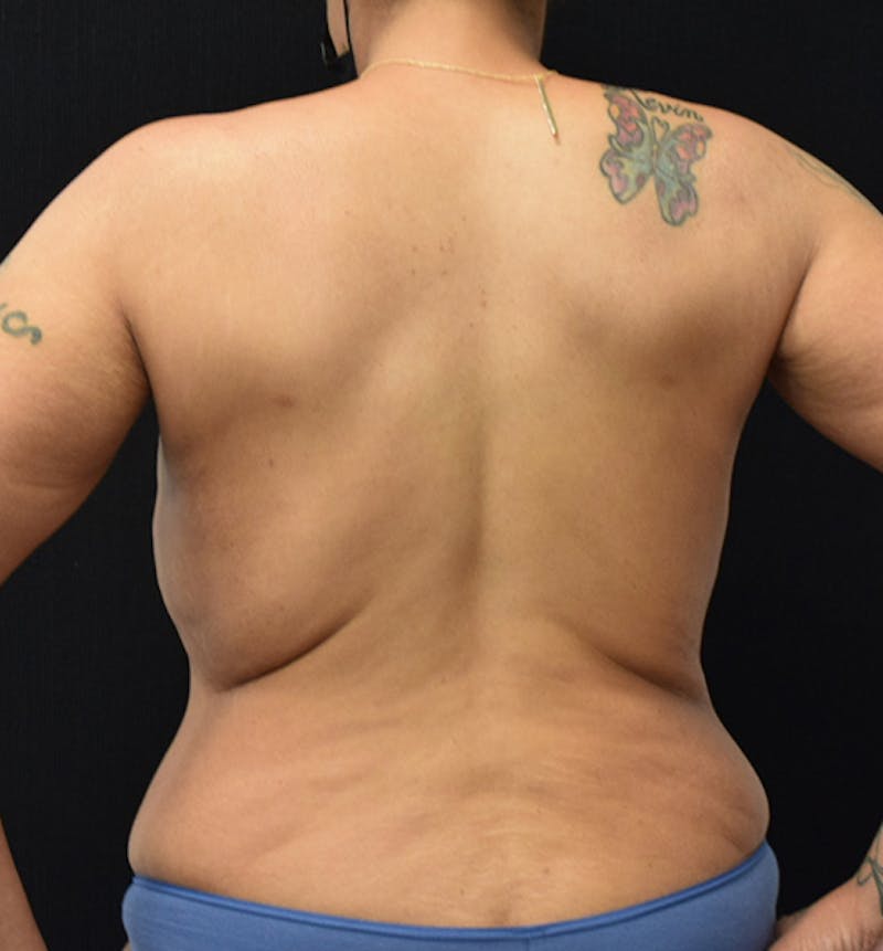 Breast Reduction Before & After Gallery - Patient 102583450 - Image 8