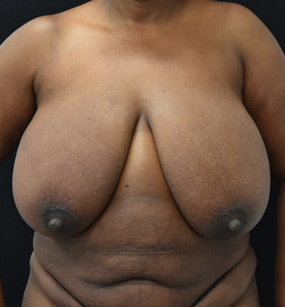 Breast Reduction Before & After Gallery - Patient 102583465 - Image 1