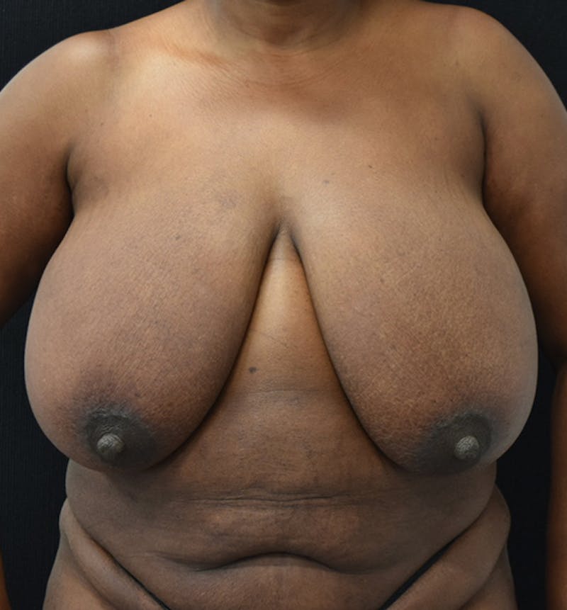 Breast Reduction Before & After Gallery - Patient 102583465 - Image 1