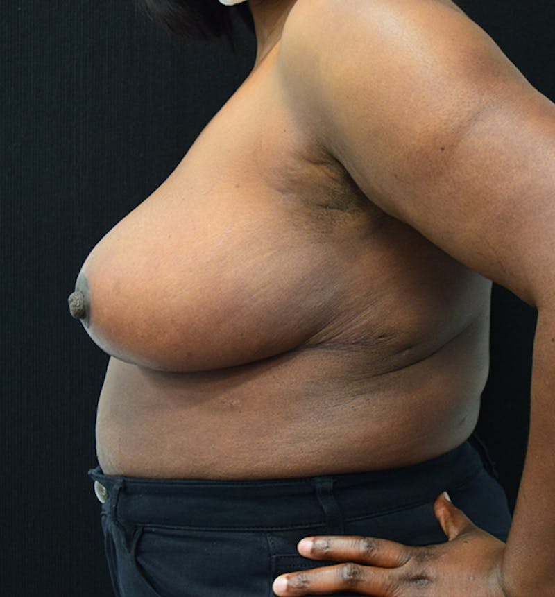 Breast Reduction Before & After Gallery - Patient 102583465 - Image 4