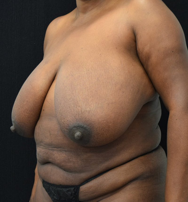 Breast Reduction Before & After Gallery - Patient 102583465 - Image 5