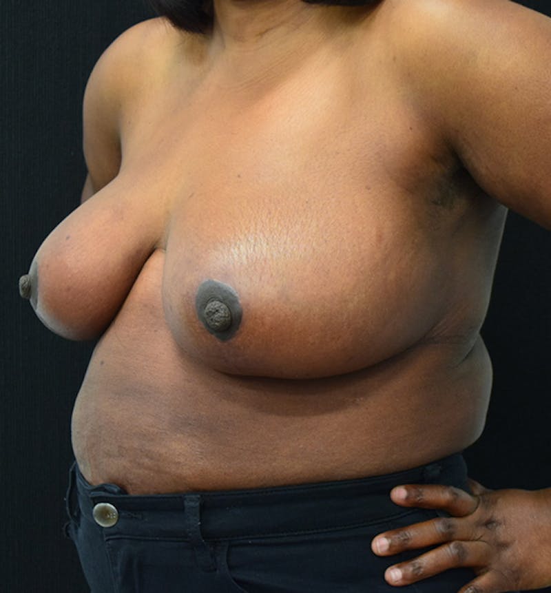 Breast Reduction Before & After Gallery - Patient 102583465 - Image 6