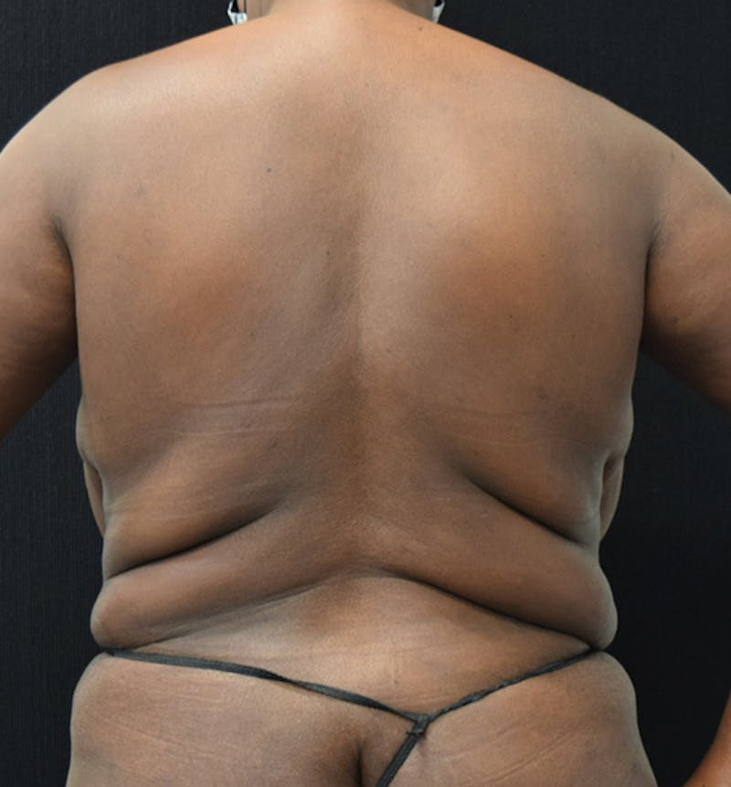 Breast Reduction Before & After Gallery - Patient 102583465 - Image 7