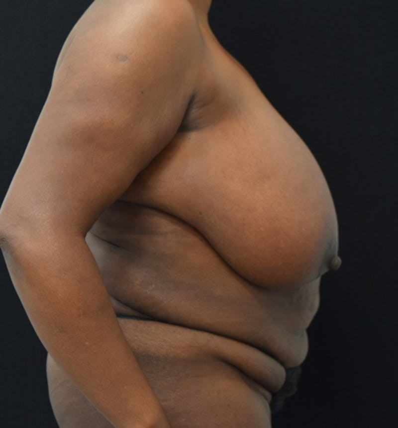 Breast Reduction Before & After Gallery - Patient 102583465 - Image 9