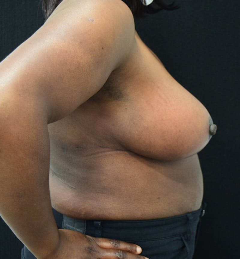 Breast Reduction Before & After Gallery - Patient 102583465 - Image 10