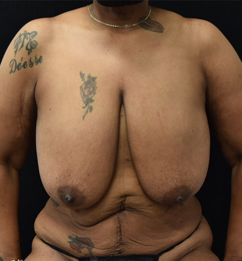 Breast Reduction Gallery - Patient 102583479 - Image 1