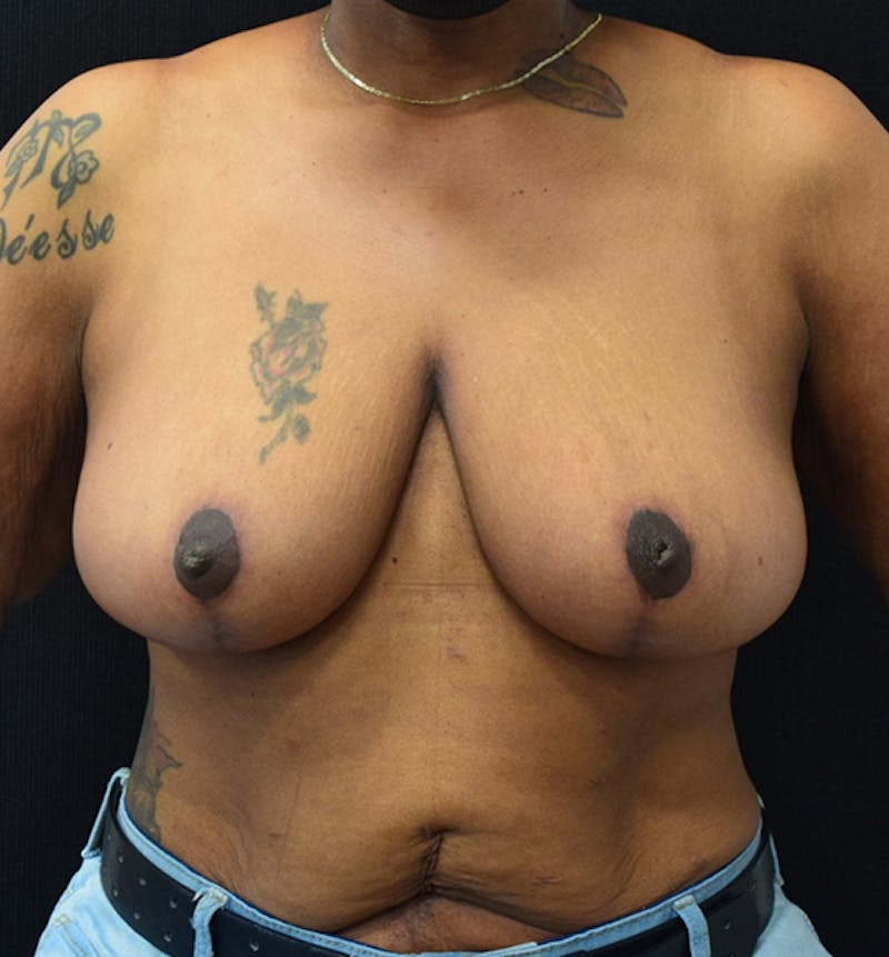 Breast Reduction Before & After Gallery - Patient 102583479 - Image 2