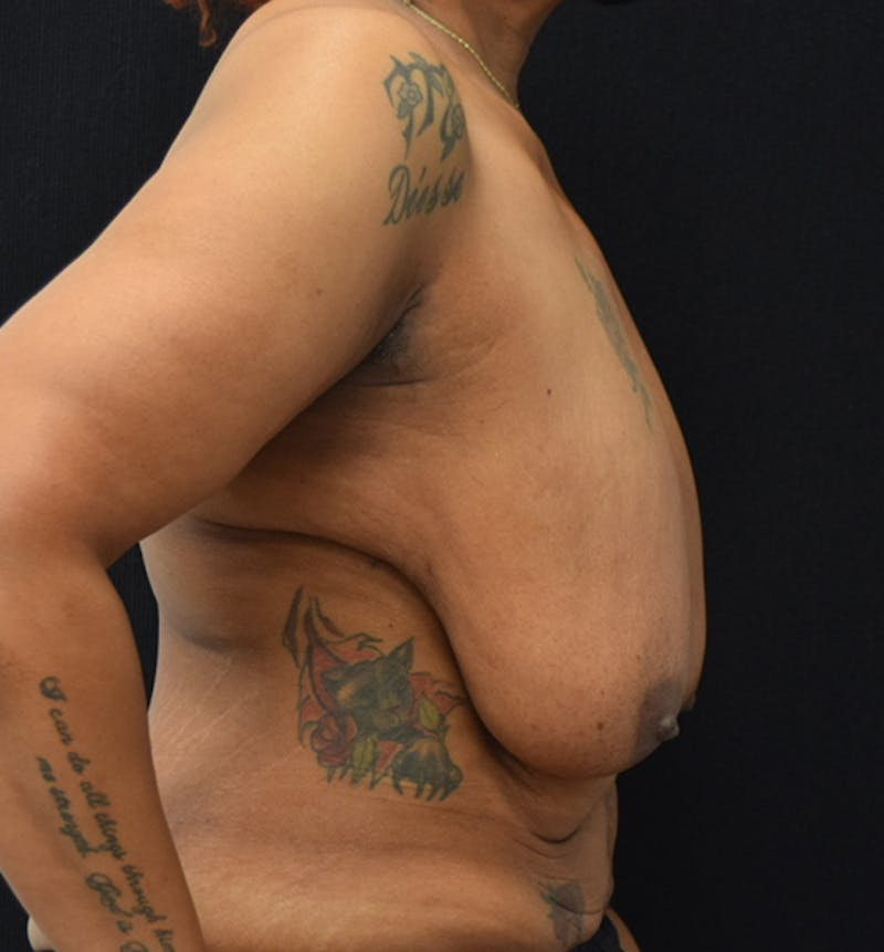 Breast Reduction Before & After Gallery - Patient 102583479 - Image 7