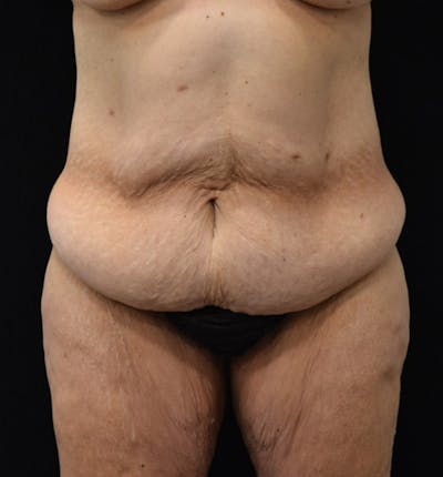 Lower Body Lift Before & After Gallery - Patient 102928332 - Image 1