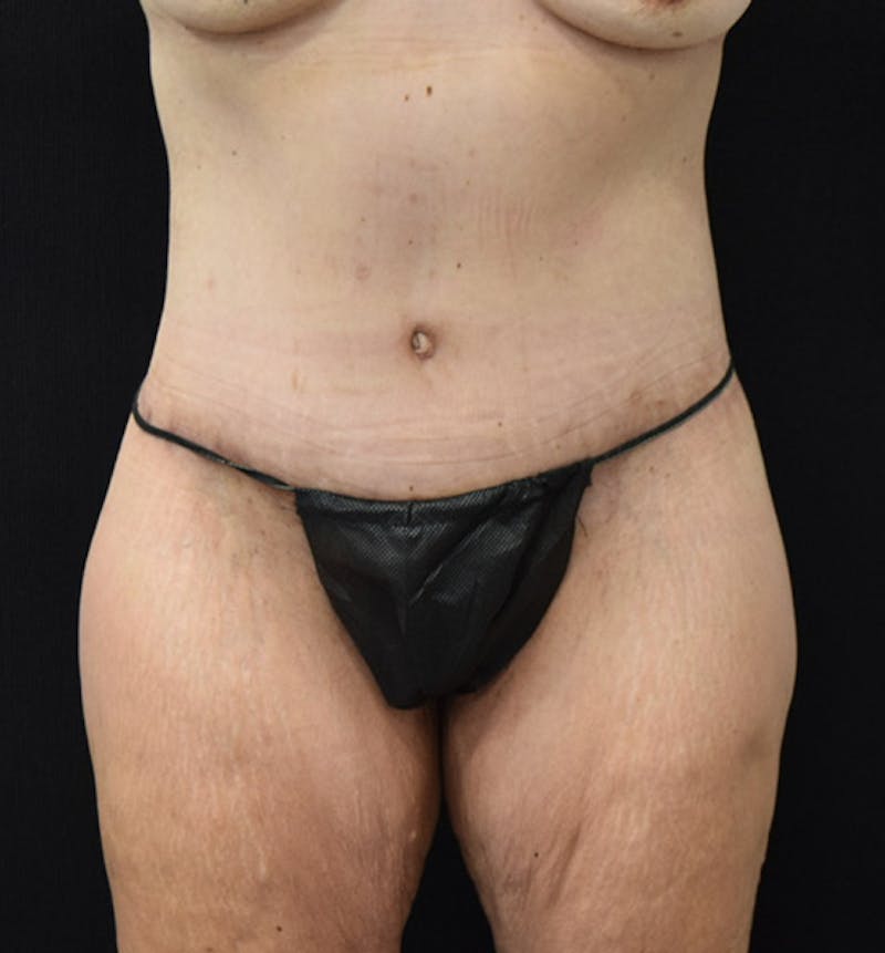 Lower Body Lift Before & After Gallery - Patient 102928332 - Image 2