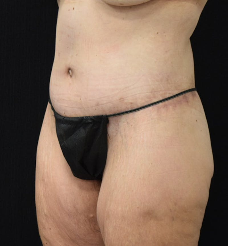 Lower Body Lift Before & After Gallery - Patient 102928332 - Image 4