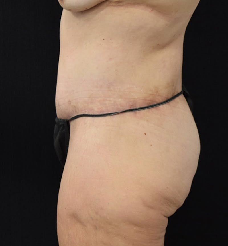 Lower Body Lift Before & After Gallery - Patient 102928332 - Image 6