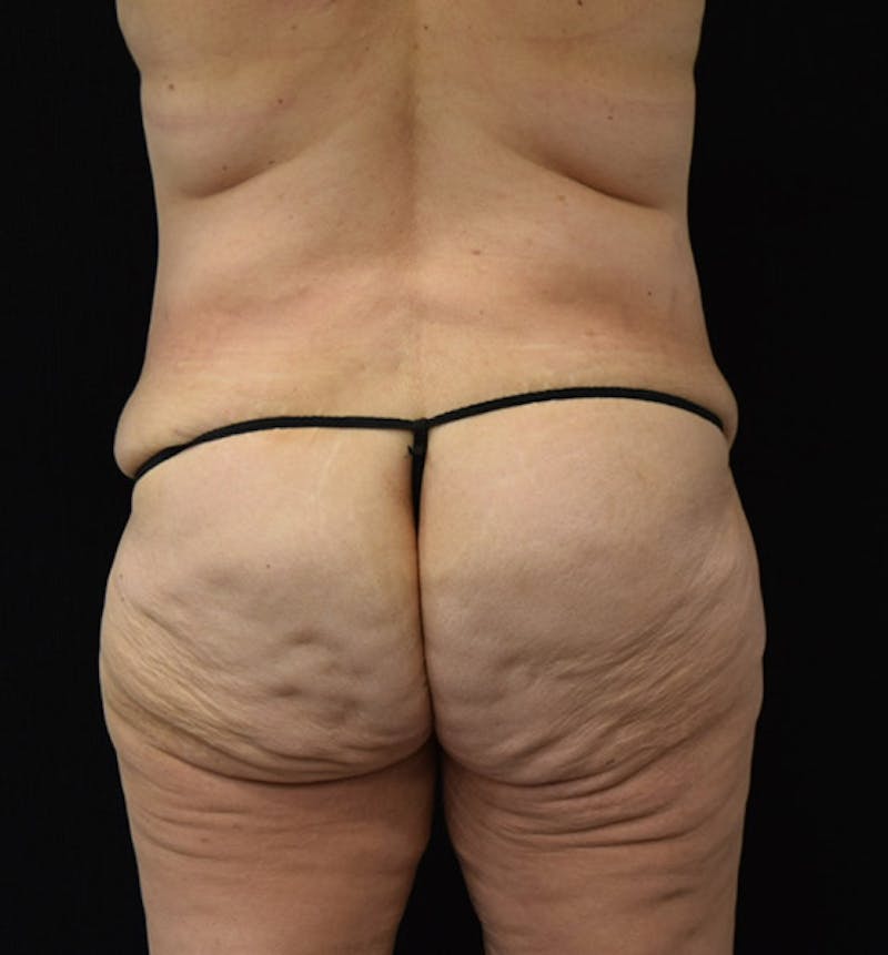 Lower Body Lift Before & After Gallery - Patient 102928332 - Image 7