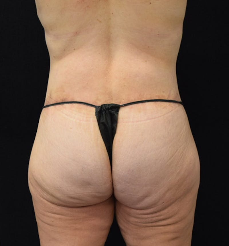 Lower Body Lift Before & After Gallery - Patient 102928332 - Image 8