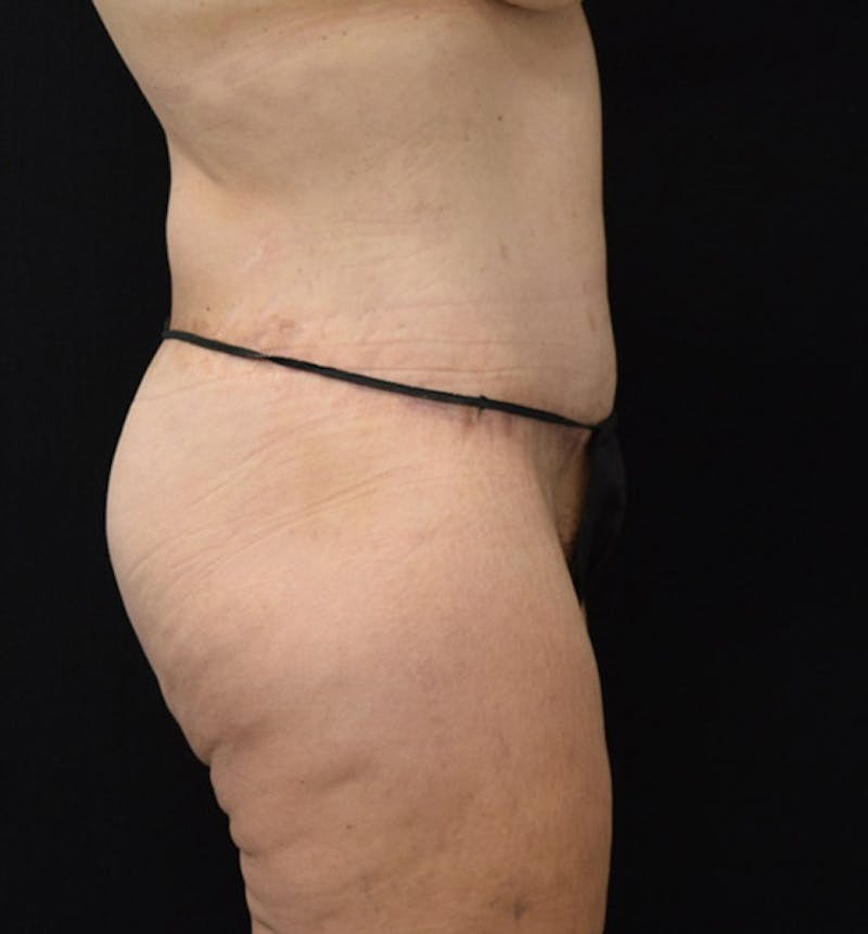 Lower Body Lift Before & After Gallery - Patient 102928332 - Image 10