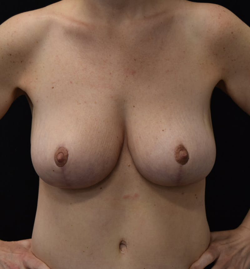 Breast Lift Gallery - Patient 117546280 - Image 2