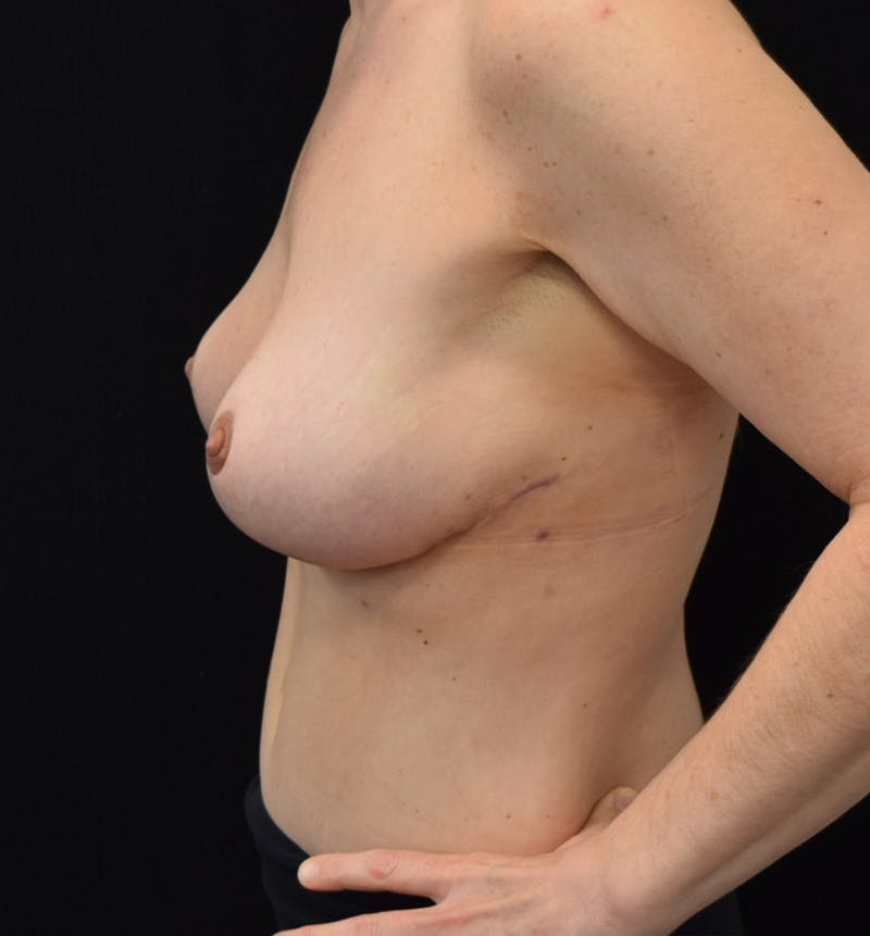 Breast Lift Before & After Gallery - Patient 117546280 - Image 6
