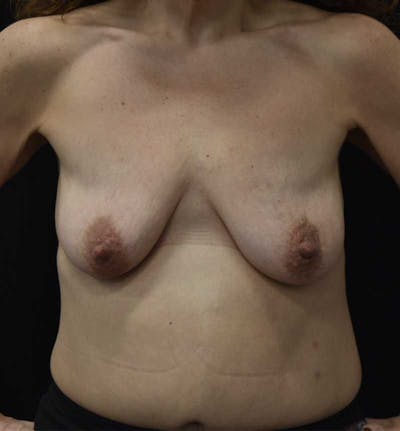Breast Lift Before & After Gallery - Patient 119931508 - Image 1