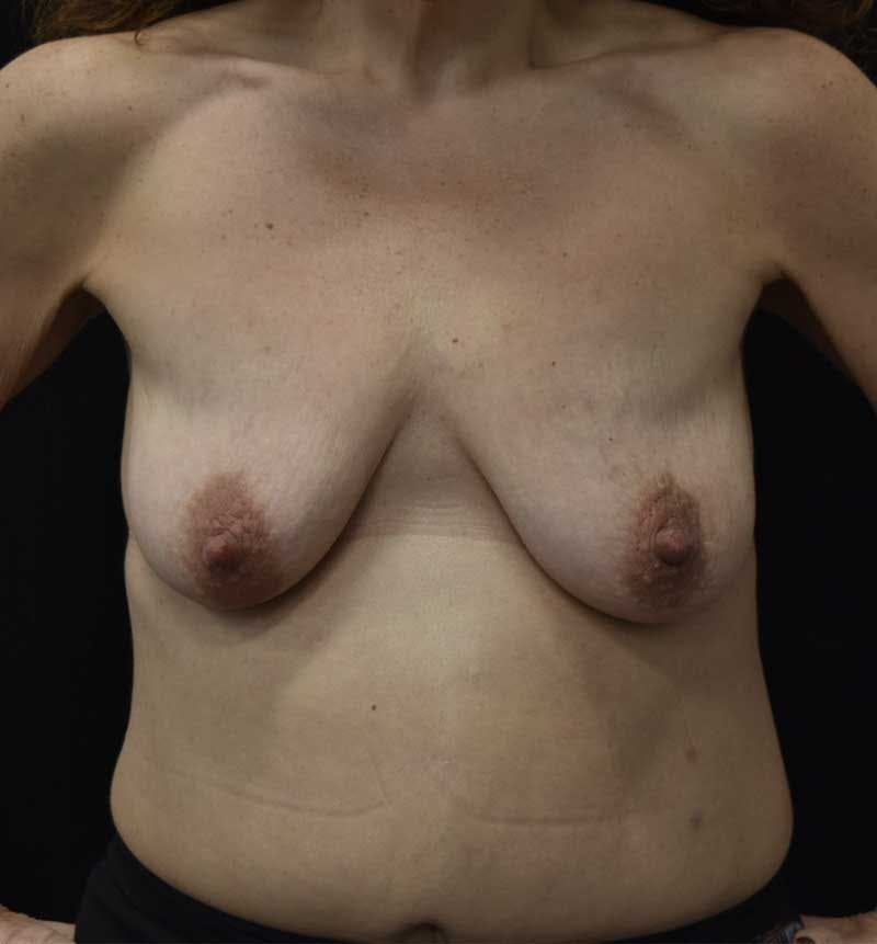 Breast Lift Before & After Gallery - Patient 119931508 - Image 1
