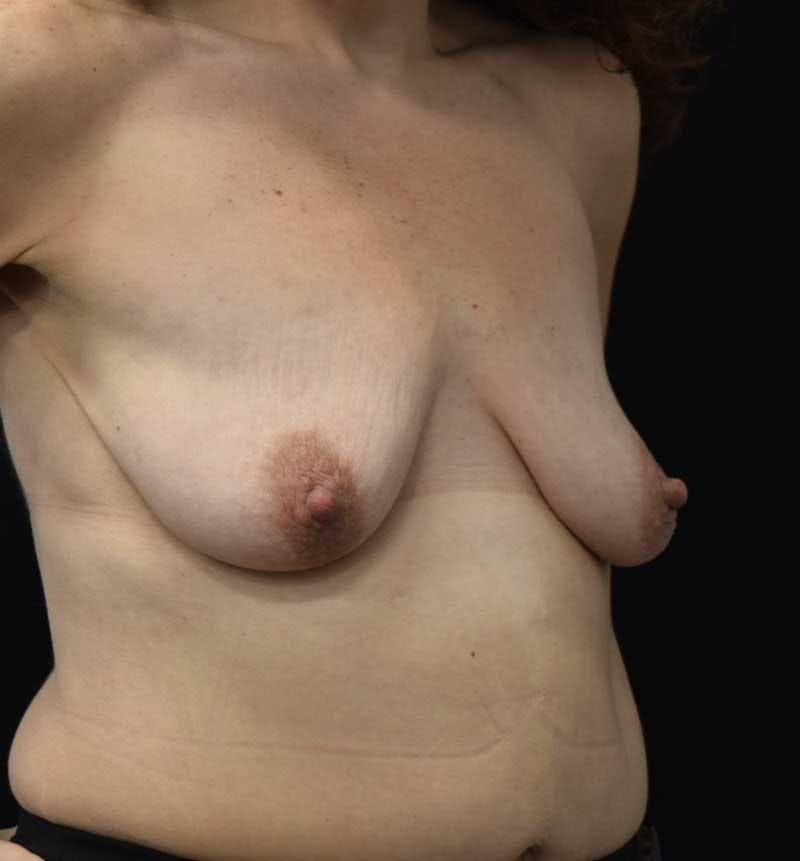 Breast Lift Gallery - Patient 119931508 - Image 7
