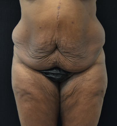 Lower Body Lift Before & After Gallery - Patient 121163172 - Image 1