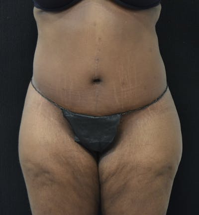 Lower Body Lift Before & After Gallery - Patient 121163172 - Image 2