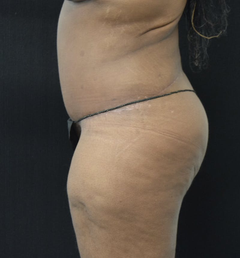 Lower Body Lift Before & After Gallery - Patient 121163172 - Image 6