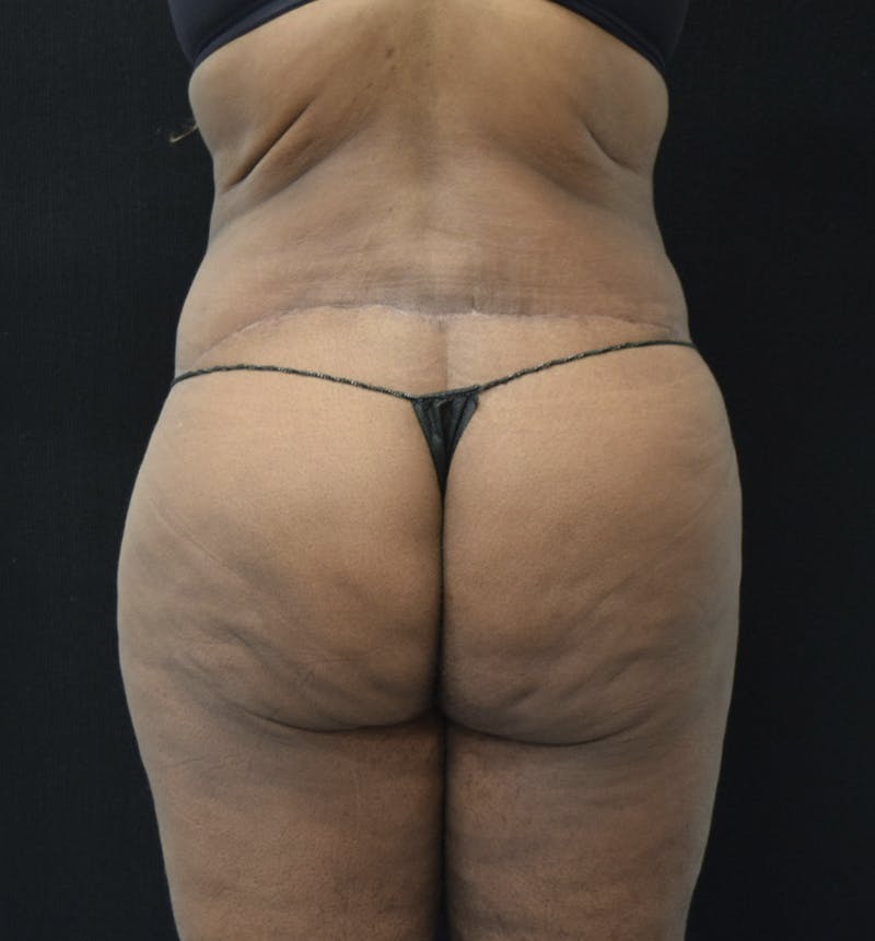 Lower Body Lift Before & After Gallery - Patient 121163172 - Image 8