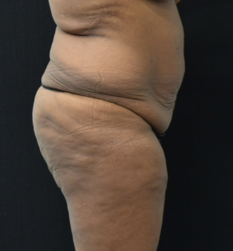 Lower Body Lift Before & After Gallery - Patient 121163172 - Image 9