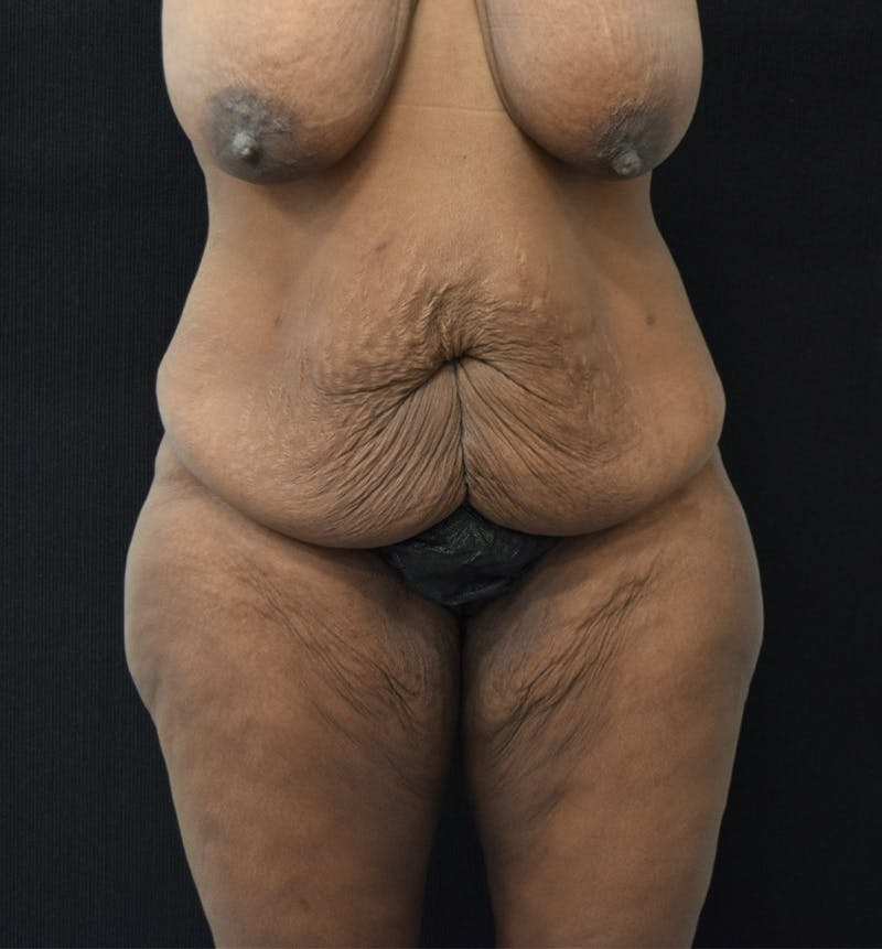 Fat Transfer Gallery - Patient 121235687 - Image 3