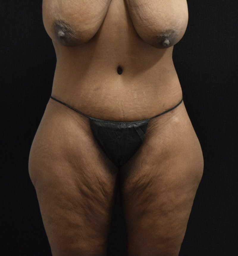 Fat Transfer Before & After Gallery - Patient 121235687 - Image 4