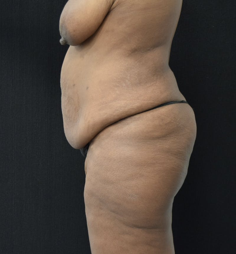 Fat Transfer Before & After Gallery - Patient 121235687 - Image 9